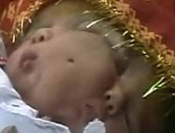 Bu bebek iki yüzlü doğdu