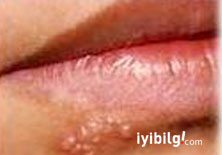 Uçuk deyip geçmeyin!